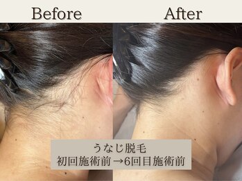 インベスト(INVEST)/うなじ脱毛