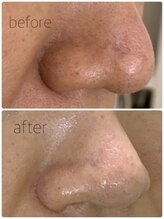 バービーフェイス 恵比寿(Barbie Face)/毛穴，凸凹、美白