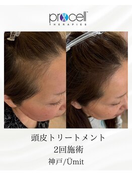 ユミト(Umit)/プロセルスカルプ