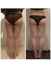 美人バスト 渋谷店/【痩身・ダイエット】 渋谷/脚☆