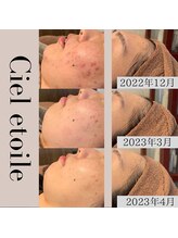 シエルエトワレ/【ニキビ特化】改善コース