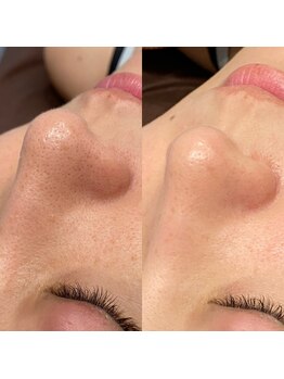 ボンズ(bonds.)/ハーブピーリング×毛穴洗浄