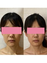 サロンドミジュ(Salon de 美jyu)/ニキビケア