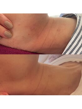 小顔フェイスラボ 鈴鹿店(小顔FaceLabo.)/◆首のシワ改善◆