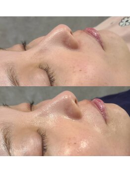 ディシェル(D cier)/Before ＆ After