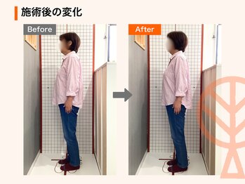 ただき接骨院 整体院 新前橋院/施術後の変化：ストレートネック