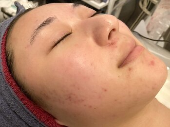 小顔コルギサロン シー(She)の写真/繰り返すニキビ悩みを改善！その場しのぎのケアではなく肌の専門家が根本から改善へ導く◎