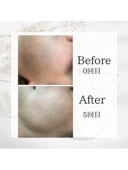 サロン ルイ(salonRui)/ひげ脱毛　before　afuta