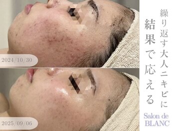 サロン ド ブラン アオヤマ(Salon de BLANC AOYAMA)/クリスティーナハーブピーリング