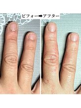 桃の木 吉祥寺店/爪はゆっくり変わります