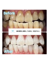 ホワイトニングショップ 甲府店/ホワイトニングの効果