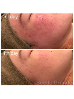 ビューティーモール(BEAUTY MALL)/パワーライトフェイシャル2回