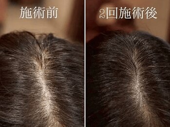 やなけん 亀戸店/髪が細くなって分け目が目立つ