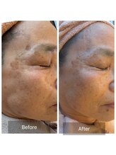 エメ(Aimer)/【70代日光性シミ結果写真☆】