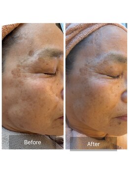 エメ(Aimer)/【70代日光性シミ結果写真☆】