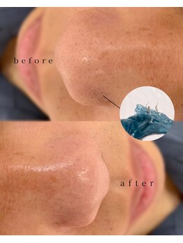 プラスアイビー 松山店(+i.b)/小鼻ケア