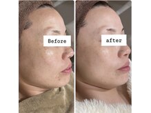 アリス(ALICE)/くすみにはハーブピーリング