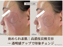 レガロビューティクリエイションズ桜川店/高濃度炭酸肌改善フェイシャル