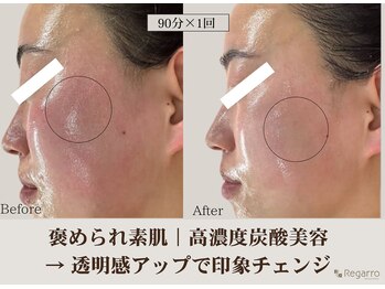 レガロビューティクリエイションズ桜川店/高濃度炭酸肌改善フェイシャル
