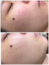 アンジェロ/【ニキビケア】肌育プログラム