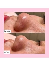 ホワイトラボ 新潟万代(White labo)/黒ずみ改善でオルチャン美肌☆