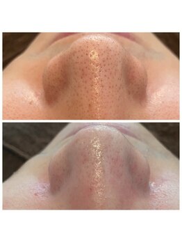 ビューティーベリッシモ(Beauty Bellissimo)/毛穴洗浄、グラスピール