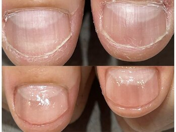 グレースレディ 大阪店/(深爪/長さだし/フィルイン)