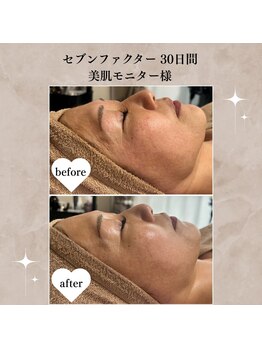 シーフェイス 横浜店(SEE FACE)/30日間美肌モニター たるみ乾燥