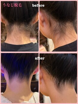 ミレボ(Me.rebo)/うなじ脱毛before→after