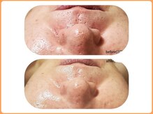 月1回ケア【before7月after10月】ゆるみ毛穴、色むら改善ハリUP