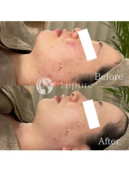 ルプレ(Lupure)/ハーブピーリング6回目