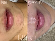 リツ(Ritsu)/ニキビケア