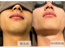 メンズアルファ/【髭】光脱毛before after 20代