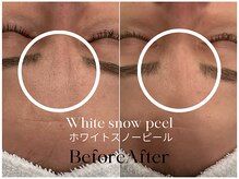 トウキョウビューティーラボ(TOKYO BEAUTY LABO.)/スノーピールBefore&After