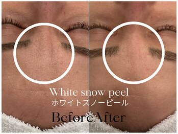 トウキョウビューティーラボ(TOKYO BEAUTY LABO.)/スノーピールBefore&After