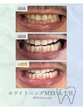 ホワイトニングミース 北千住店(MYS)/当店の通い放題のご利用結果２