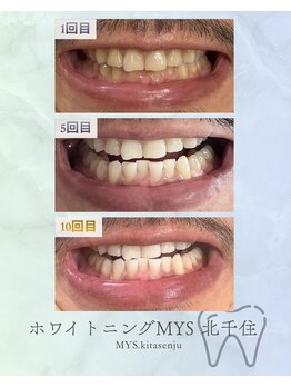 ホワイトニングミース 北千住店(MYS)/当店の通い放題のご利用結果2