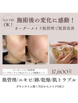 ウル 大阪野田店(Ulu)の写真/【看護師の肌管理】野田でニキビ改善するならココ!繰り返す肌悩みから卒業!早く来れば良かった!の声続出◎