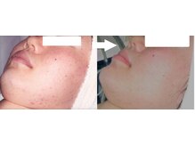 サロンドエステケイワイ(de KY)/フェイシャル☆ニキビ改善