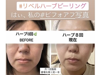 ルキア(LUKIA)/オーナーの凸凹肌もリベルで激変