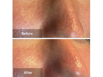 リノリー(rinory)/ハイドラフェイシャル