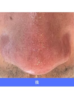 レイ(R.E.I)/ツルツルお鼻に生まれ変わる！