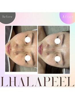 バブルビューティー(Bubble beauty)/ララピール・LDM・LED1回施術後