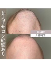 アカラビューティー(Akala Beauty)/ひげ脱毛〈５回終了！〉