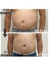 ナニワ ビューティー(naniwa beauty)/WINBACKお腹集中