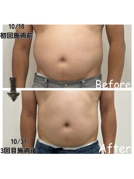 ナニワ ビューティー(naniwa beauty)/WINBACKお腹集中