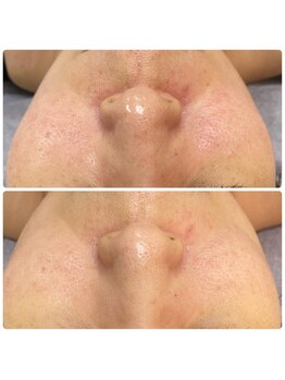 リセットラボ 本店(Reset Lab)/ハーブピーリング before→after