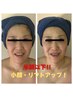 小顔リフトアップ！脂肪分解液導入！半額以下！¥10,000