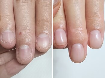 深爪/表面のボコボコ/横溝