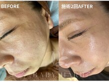 フィズ 戸塚店(FIS)/☆ハーブピーリング☆都度払い